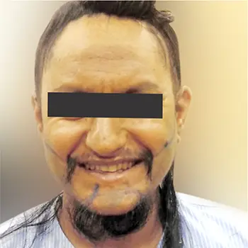 Beard_restoration Before